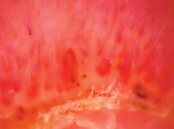 Resim 1. Kapilleroskopik değerlendirme sonucuna göre kapiller dilatasyon zeri, dallanmış, sarmal yapmış ve uzamış kapillerler neoanjiyogenez olarak değerlendirildi.