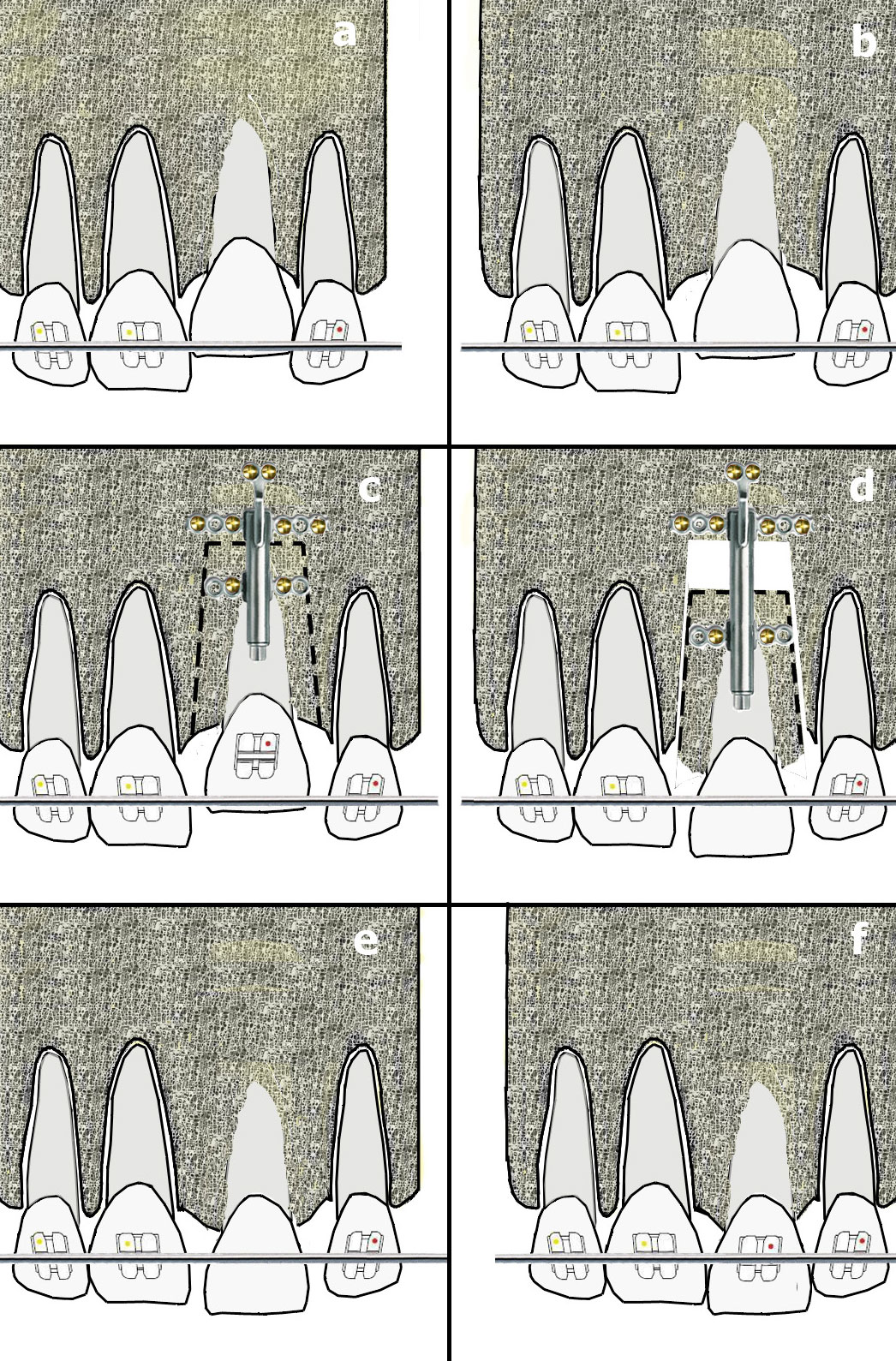 Şenışık ve Akalın 2016 Şekil 3 Tek diş dento-osseöz osteomisi ve kemik destekli alveoler distraksiyon: a. Ankiloze diş hariç tüm dişler braketlenir ve seviyelenir; b.