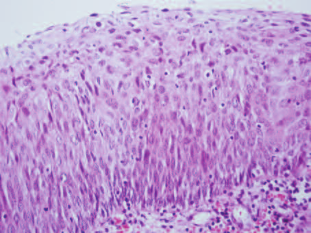 Medical Pathology lar ve skuamöz intra-epitelyal lezyonlar olarak iki grupta sınıflandırıldığında, ve ayrıca PS de ASC-US ile ASC-H tanılı olgular dışlandığında, özgüllük %100, duyarlılık %75,9,