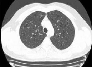 Respiratory Case Reports Pulmoner langerhans hücreli histiositozis (PLHH) X; langerhans hücreli histiositozisin alt grubu olup akciğerlerde langerhans hücre infiltrasyonunun görüldüğü, nedeni