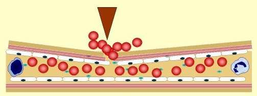 ENDOTEL HASARI Kollajenin açığa çıkması VAZOKONSTRİKSİYON PLATELET REAKSİYONLARI gevşek trombüs stabil