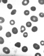 Herediter Sferositoz Resim 1. Mikrosferositik hücreler lizis 100 80 60 40 20 0 0.1 0.