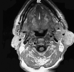 Kelefl E ve ark. Tablo 1. Parotis bezinden kaynaklanan kitlelerin histopatolojik da l m. Histopatolojik tan Olgu say s Histopatolojik tan Olgu say s (%) (%) Benign Malign Pleomorfik adenoma 48/98 (48.