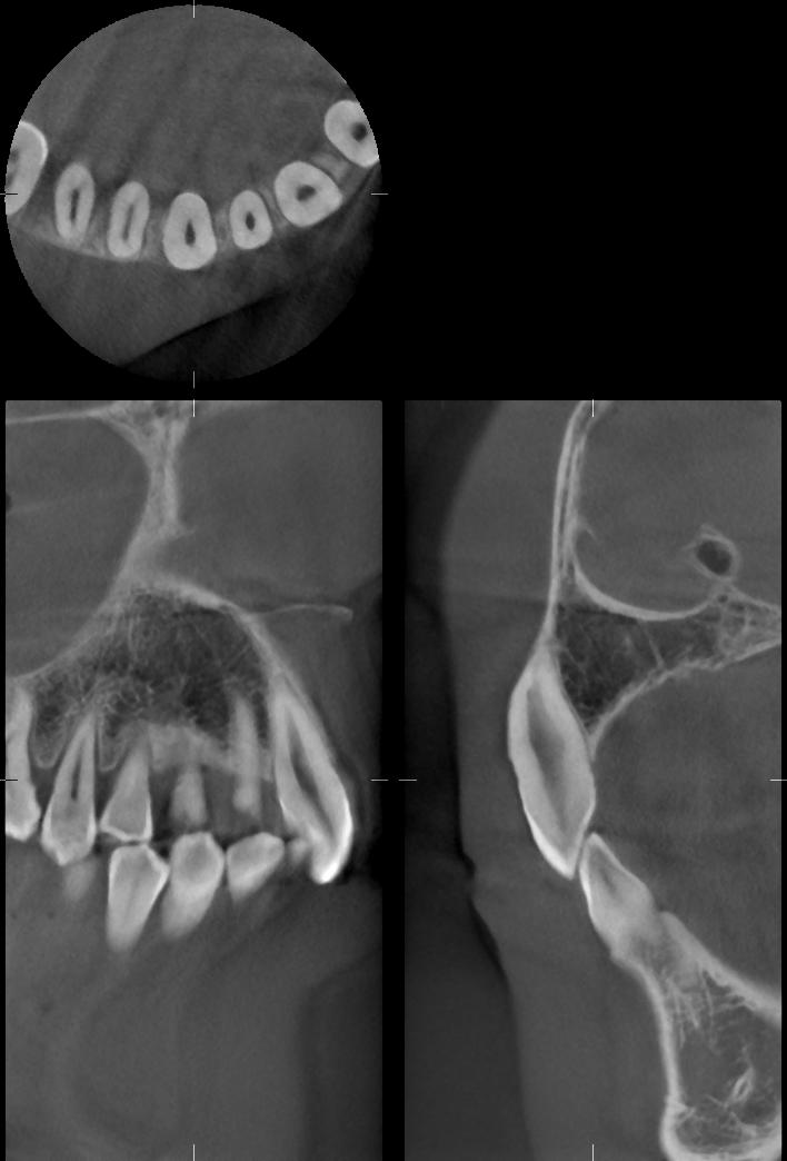 Tomografide Doz Yönetimi Görüntü Karşılaştırma (Sağ yan kesici dişler Φ40 H80 mm) Doz azaltma