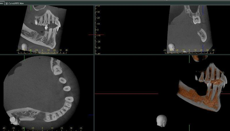 Kullanıcı Dostu Yeni Yazılım Volume görüntüsü Hacim kesme örneği Volume Rendering: Kafatasının kemik görüntüsü 3 boyutlu olarak simule edilir ve ekrana getirilir.