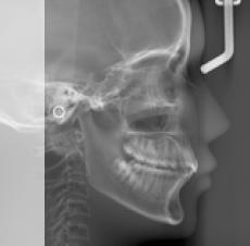 4 Farklı Segmentte Sefalometrik Çekim Eğer inceleme için gerekli değilse, görüntüleme alanı iç kulak kanalı
