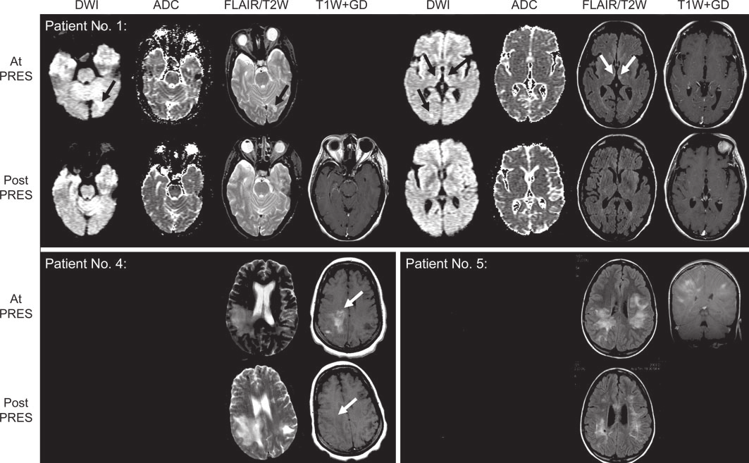 05_155-160 (712-717) 5/23/09 12:02 PM Page 158 Şekil Nöromiyelitis optika spektrum hastalığı posteriyor geri dönüşümlü ensefalopati sendromu olan üç hastanın nörogörüntülemesi 1.