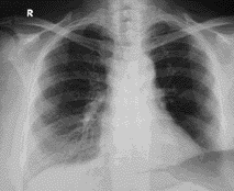 SWYER-JAMES-MACLEOD SENDROMU lerde bronflektazi ile uyumlu bulgular saptand. Hastan n d- dimer düzeyi ve alfa-1 antitripsin düzeyi normal s n rlardayd.