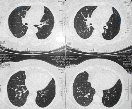 ZM R GÖ ÜS HASTANES DERG S Resim 2. Sol akci erde lingula ve alt lobda havalanma art fl, bronflektazi, sol pulmoner arterde küçülme. Resim 3.