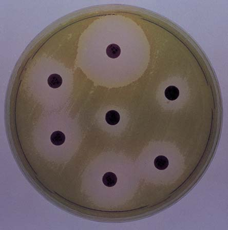 Pseudomonas aeruginosa Sufllar nda Görülen Beta-Laktam Gönüllü N, Gürol Y, Bülüç M, Bal Ç. Resim 3. Genifllemifl Spektrumlu Beta-laktamaz Fenotipi. Resim 5. Porin Direnci. Resim 4.