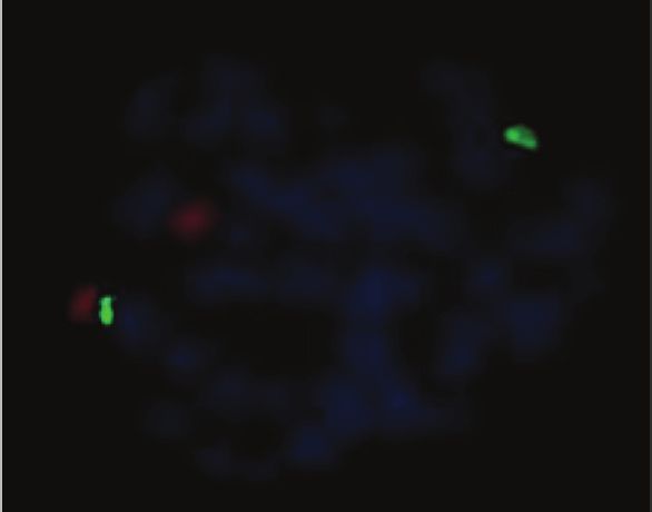 KURU ve Ark. Der(21)T(17;21) ve 13q Delesyonlu Bir KLL Olgusunun Sitogenetik, FISH ve Qrt-PCR İle İncelenmesi 2016;6(3):141-145 143 188 sitogenetik açıdan incelenmiştir.
