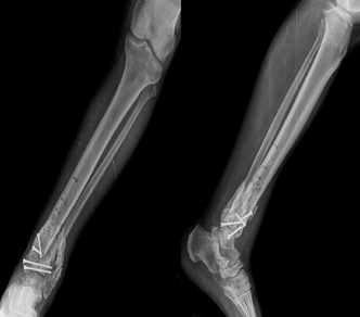 210 TOTBİD Dergisi (a) (b) (c) (d) Şekil 1. a d. Elli bir yaşında diyabetik ve periferik nöropatisi olan erkek hasta (a). Distal tibia ve fibula anatomik kilitli plağı ile tespit (b).