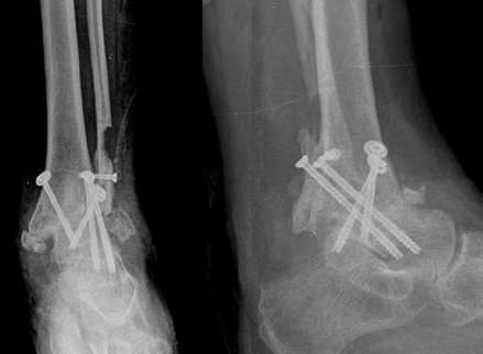 Osteoporotik ve nöropatik ayak bileği kırıklarında tedavi yaklaşımı 211 (a) (b) (c) Şekil 2. a d. Altmış beş yaşında diyabetik kadın hasta. Ayak bileği kırığı sonrası tespit yetmezliği (a).