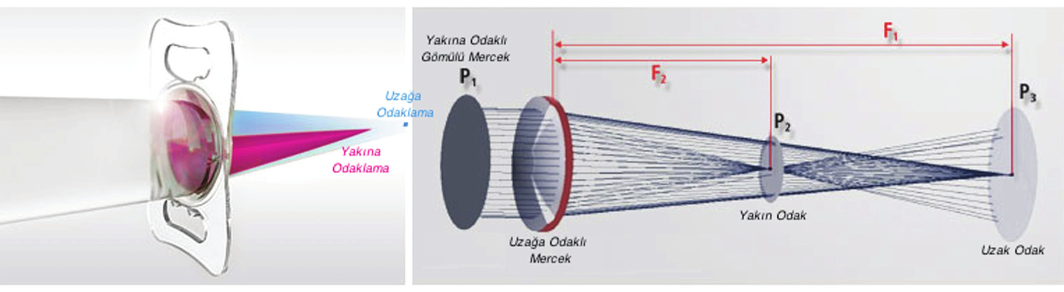 240 Lentis Mplus LS-313 MF30 Multifokal ve Lentis Mplus Torik... Tablo 3: Multifokal toric IOL hastalarında uzak görme snellen değeri değişimleri. Düzeltilmemiş Düzeltilmiş Preoperatif 0.33 0.52 1.