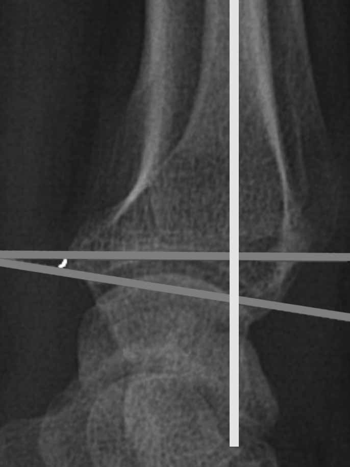 42 Distal Radius Kırıklarında KMY-Fonksiyonel ve Radyolojik Sonuç Türk Osteoporoz Dergisi 2015;21: 40-5 saptanmadı (p=0,216).