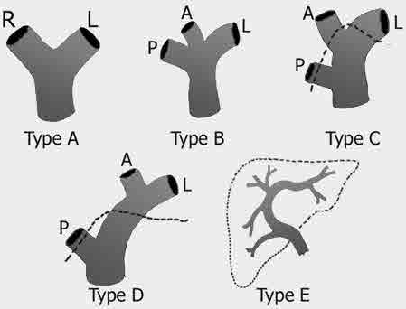 Resim 19. Portal ven varyasyonlarının şematik çizimi (29). 2.4.3.