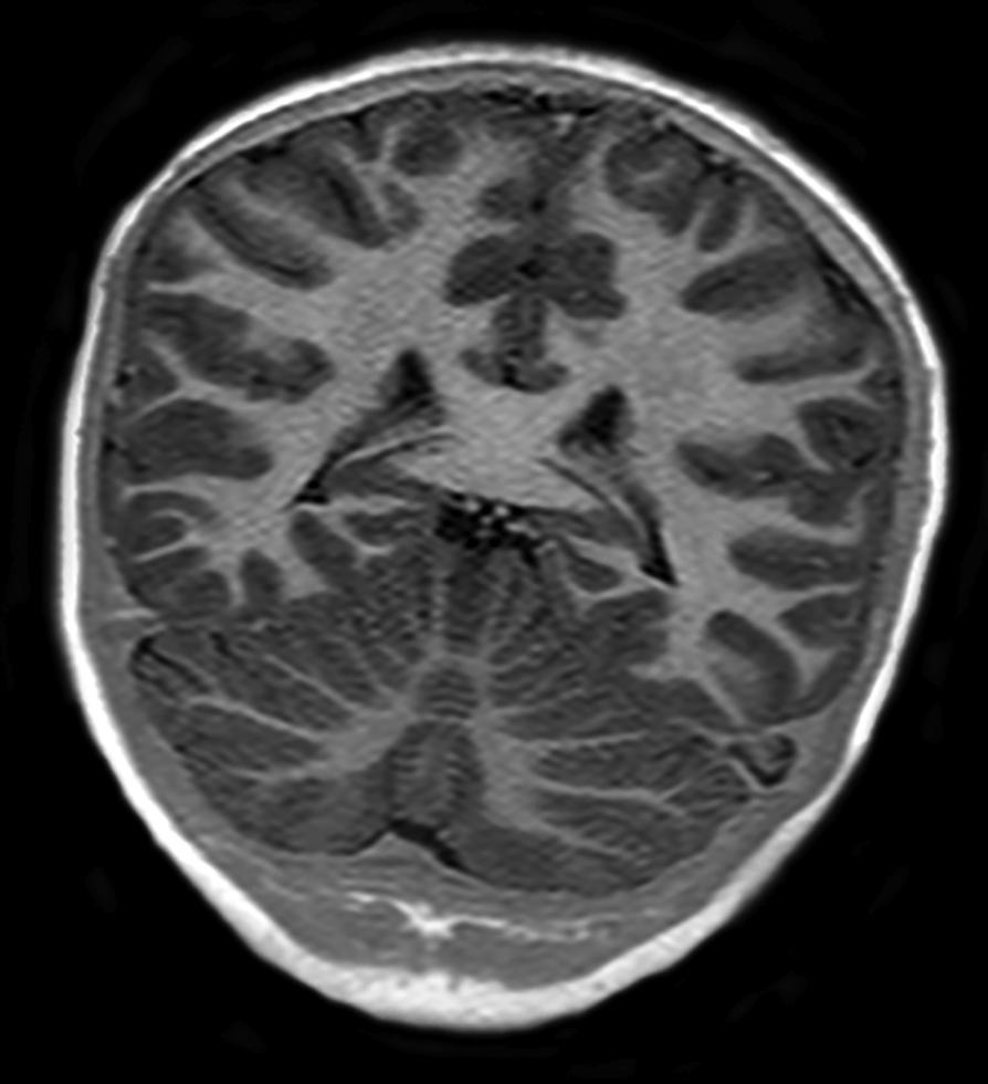 Şekil 1. Aksiyel T2-A (A) ve koronal Inversion Recovery (B) MR görüntülerde inferior temporal girusun herniyasyonu görülmektedir.