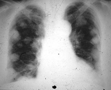 Metastatik akciğer nodülleri genellikle iyi sınırlı, yuvarlak ve düzgün kenarlı olarak tarif edilirler. Akciğerin metastatik hastalıklarının %75 i multipl lezyonla seyreder.