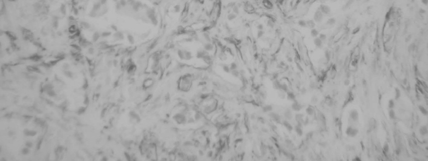PROSTAT KANSERİ VE NEOANJİYOGENEZİS (Prostate Carcinoma and Neoangiogenesis) varlığı, nöral invazyon, lenf düğümü metastazı arasında anlamlı ilişki saptanmamıştır (p>0.05).