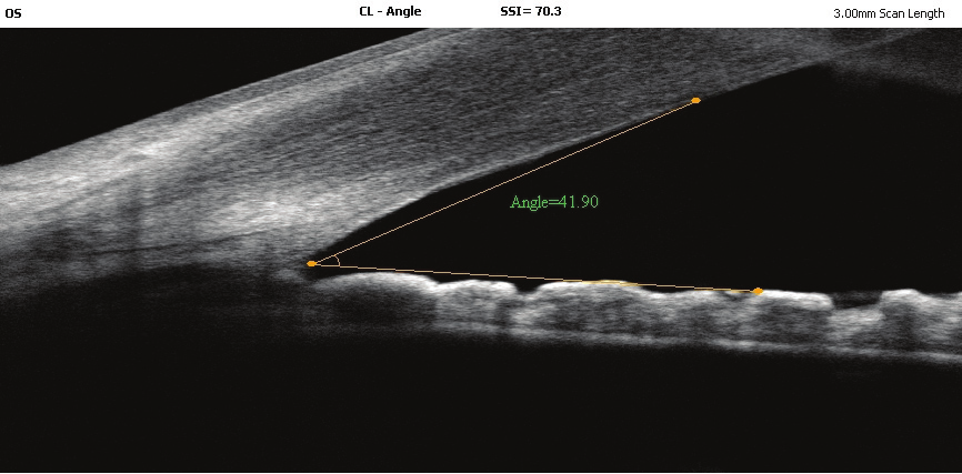 Glo-Kat 2014;9:9-13 Bayhan ve ark. 11 Resim 1: Sirius ile alınan açı görüntüsü. Spektral Optik Koherens Tomografi RTVue-100 OKT cihazı 830 nm ışık kaynağı ile saniyede 26.