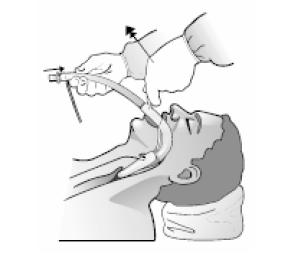 ağız içinden çıktığında birleģtirici çubuk tüpten ayrılır ve tüpün proksimal ucuna konnektör bağlanarak anestezi