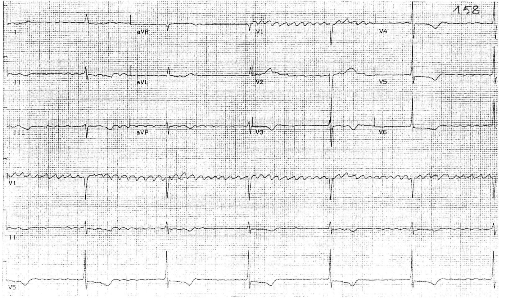 EKG ye göre hangisi yanlıştır?