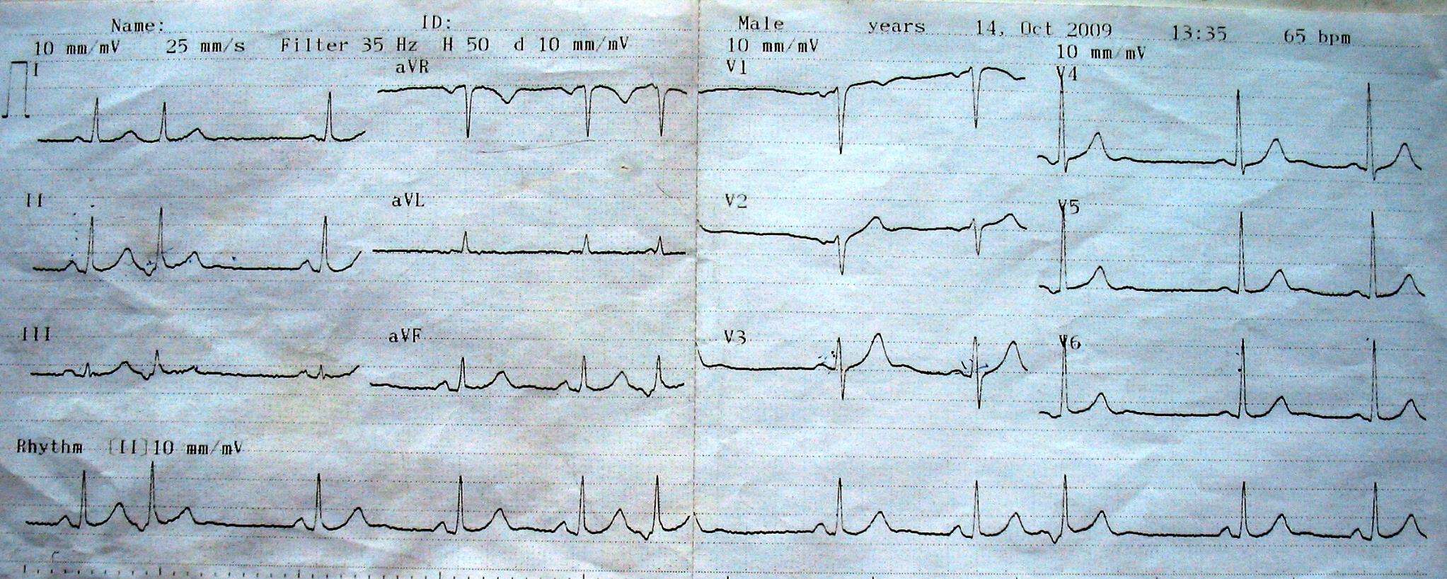 Çarpıntıdan yakınan 36 yaşında kadın. Çarpıntı yakınması olduğu sırada çekilen EKG ye göre tanı?