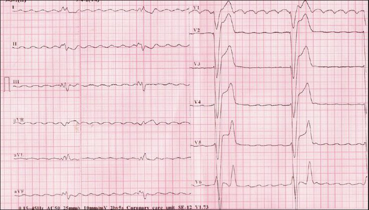 EKG bulgunuz nedir?