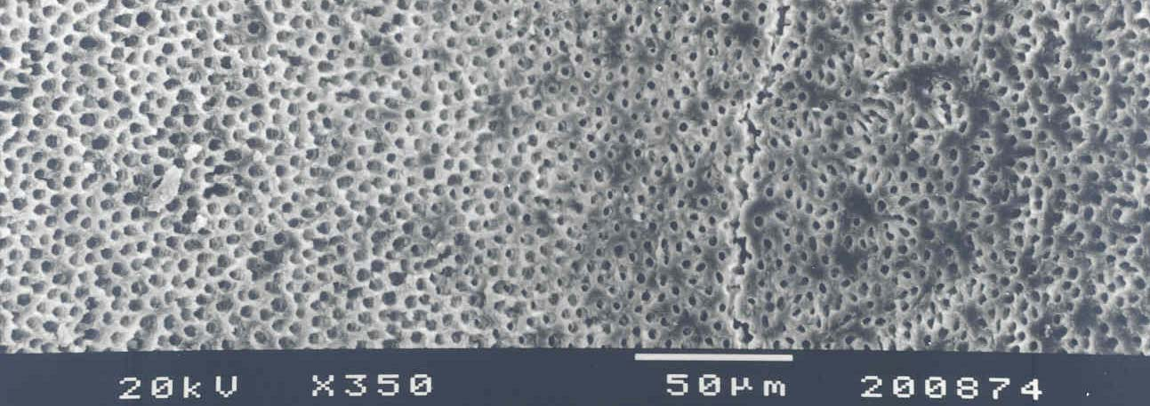 Resim11: EDTA+NaOCl koroner 1/3