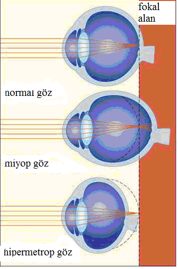 Miyop, hipermetrop göz kusurları Hipermetropi (Hipermetrop) Uzakta bulunan nesneleri görüp yakında bulunan nesneleri görememeye hipermetropi (hipermetrop) denir.