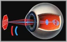Astigmatizma (Astigmatizm) Korneanın veya lensin kırma yüzeylerinin düzgün olmaması nedeniyle ışık her yerde eşit olarak kırılmaz.
