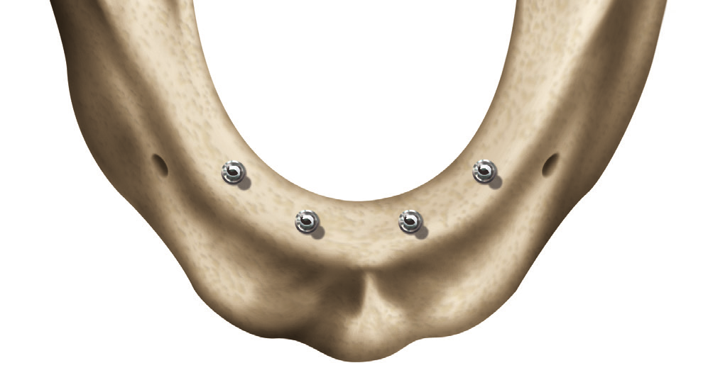 Cerrahi İşlemler Giriş Inclusive Mini Implant lar için yerleştirme protokolü minimum düzeyde invazif olarak değerlendirilir ve protokole kesinlikle uyulması gereklidir.