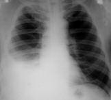 32 Plevra Hastal klar fiekil 1. PA radyografide sa lateral kostofrenik sinüsün kapal oldu u görülmektedir. fiekil 2.