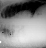 34 Plevra Hastal klar a b fiekil 3. Subpulmoner s v ; PA radyografide (a) sa da psödodiyafragmatik kontur izlenmektedir.