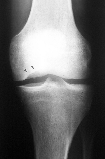 Resim 1: Yan grafide femoral kondildeki osteokondral kırık (ok ile işaretlenmiştir). Resim 2: Medial femoral kondilde yerleşmiş osteokondritis dissekans (Ön arka grafi).