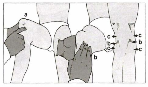 Şekil 6: Kıkırdak yaralanmalarının tanısında medial ve lateral femoral kondil haasasiyetinin