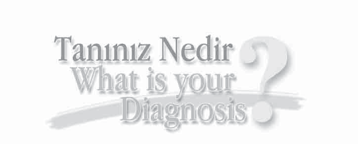 Gebe Kadında Dar QRS Kompleksli Tașikardi: Tanınız Nedir? Dr. Sedat KÖSE*, Dr. Ayhan KILIÇ**, Dr.