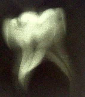 1. Süt dişlerinin okluzal yüzeyde belirgin kavitasyon göstermesi ve kök rezorpsiyonun koronal 1/3 lük kısmı geçmemesi (Resim 23), 2.