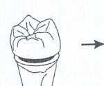 Resim 29: Dentin çubuk örnekleri Resim 30: Tek çubuk örneği Şekil 5: Dentin çubuklarının elde edilmesinin şematik görüntüsü 5.