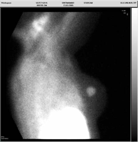 Meme Lezyonlarında Tc-99m MIBI Sintimamografi (DCIS) ve normal sintigrafik pattern izlenen diğer bir vakada ise görüntülemeden 2 hafta önce tamamlanmış kemoterapi ile bunu takiben, önceden palpabl