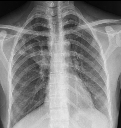 SANTRAL BRONŞ TÜMÖRÜNÜ which was mimicing the central bronchial tumor, and successfully treated with anti-tuberculosis treatment is presented in this study.