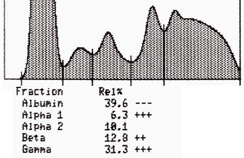 Ankara Üniv Vet Fak Derg, 56, 2009 15 Tablo 1: Sağlıklı ve şap hastalıklı danalarda serum proteinlerinin elektroforetik dağılımı Table 1: Electrophoretic distribution of serum proteins of healthy