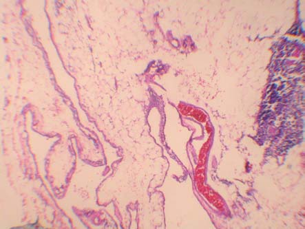 Ertuğrul M, Bayram Selvi Ü, Damadoğlu E, Arınç S, Sulu E, Yağcı Tuncer L, Atasalihi A, Yılmaz A. Thymic cysts are rarerly encountered lesions which are only 1 to 2% of all mediastinal masses.