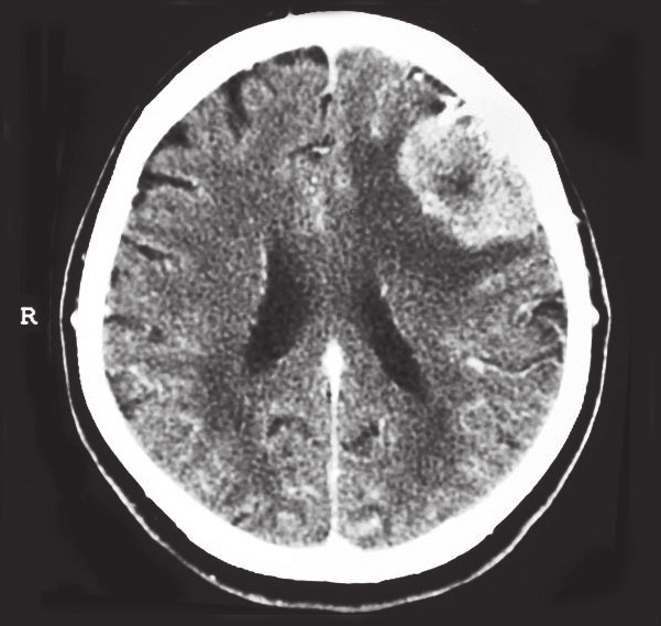 Giriş Beyin tümörlerinin yaklaşık %20 sini oluşturan meningiomlar, araknoidin meningotelyal hücrelerinden gelişen tümörler olup, çoğunluğu benign ve Dünya Sağlık Örgütü (DSÖ) ne göre histolojik