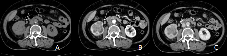 Resim 3: Grade 4 berrak hücreli RHK u olan olguda, BT de böbreğe sınırlı görünümdeki lezyonda, ok işareti ile gösterilen milimetrik bir odakta perirenal yağ doku invazyonu saptanması tümörün evresini