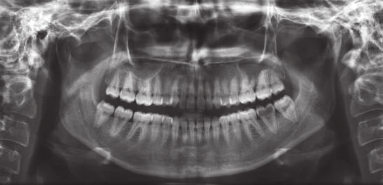 Resim 3. Hipertaurodontizm. Resim 4. Piramidal tip taurodontizm. Tablo 1. Cinsiyete göre taurodontizm dağılımı.