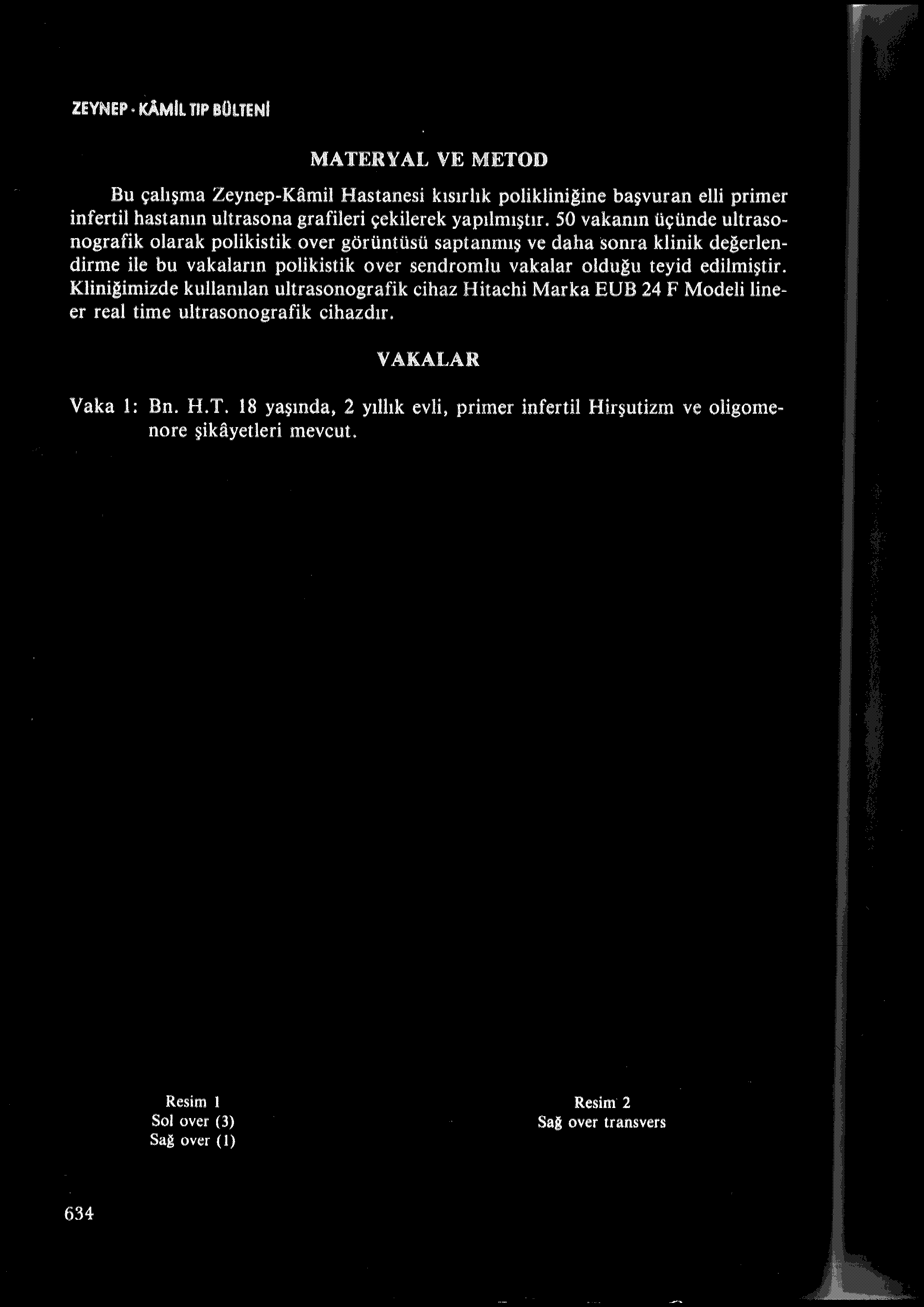 ZEYNEP KAMiL TIP BÜLTENi MATERYAL VE METOD Bu çalışma Zeynep-Kamil Hastanesi kısırlık polikliniğine başvuran elli primer inf ertil hastanın ultrasona grafileri çekilerek yapılmıştır.