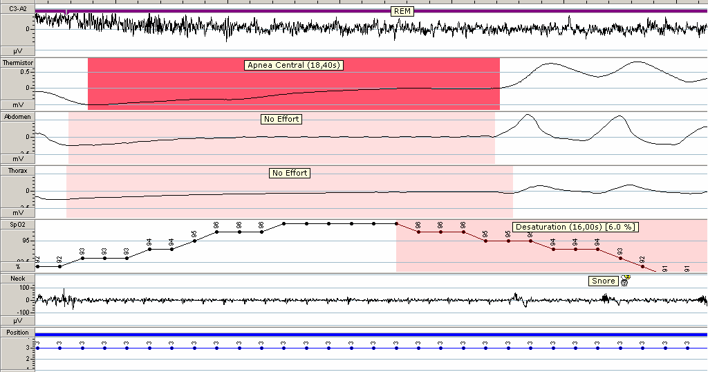 SANTRAL UYKU APNE SENDROMU AHI > 5 ve apnehipopnelerin % 50 den fazlasının santral tipte