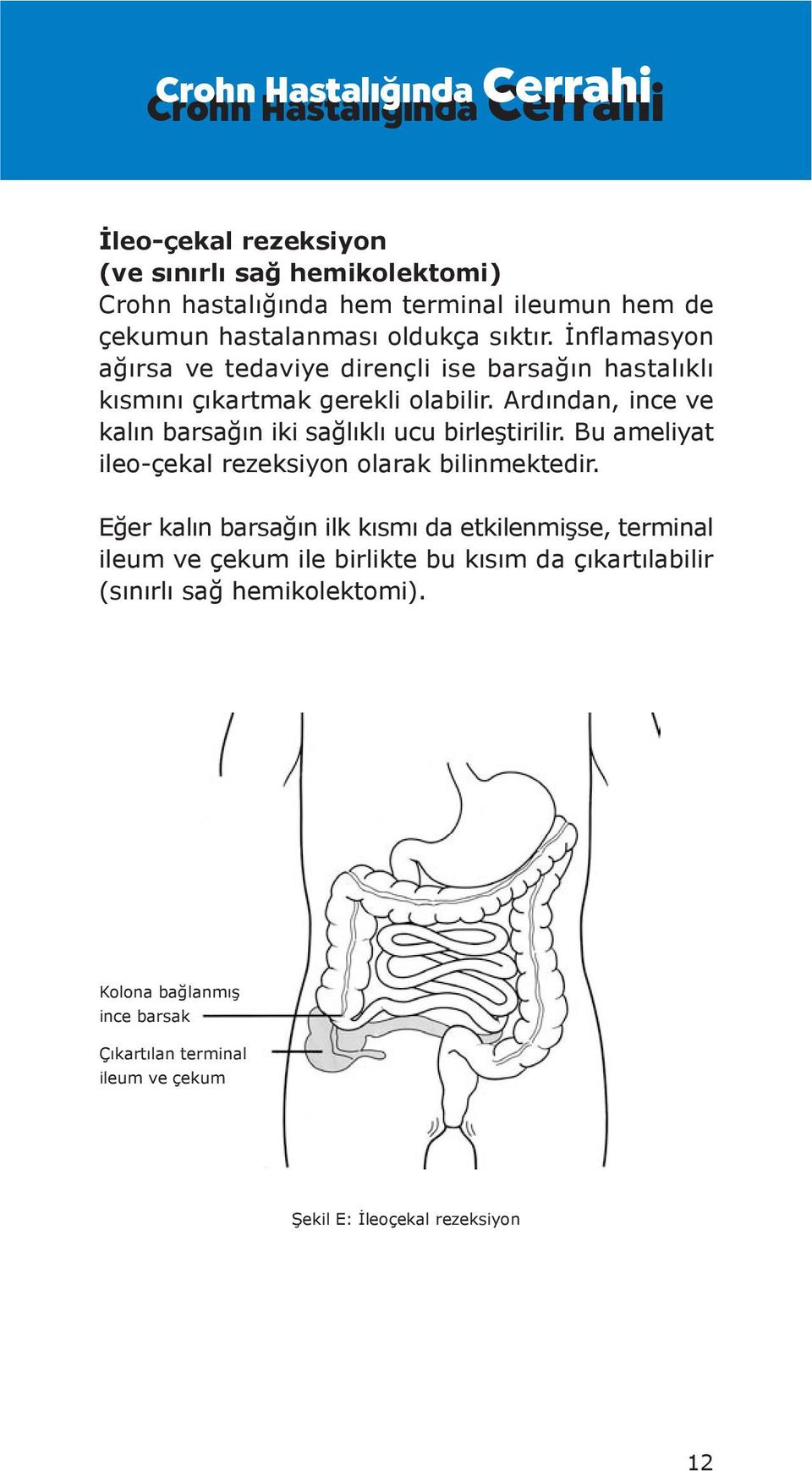 Ardından, ince ve kalın barsağın iki sağlıklı ucu birleştirilir. Bu ameliyat ileoçekal rezeksiyon olarak bilinmektedir.