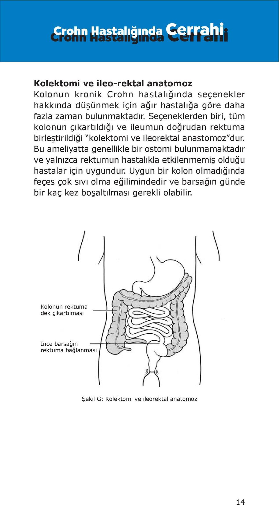 Bu ameliyatta genellikle bir ostomi bulunmamaktadır ve yalnızca rektumun hastalıkla etkilenmemiş olduğu hastalar için uygundur.